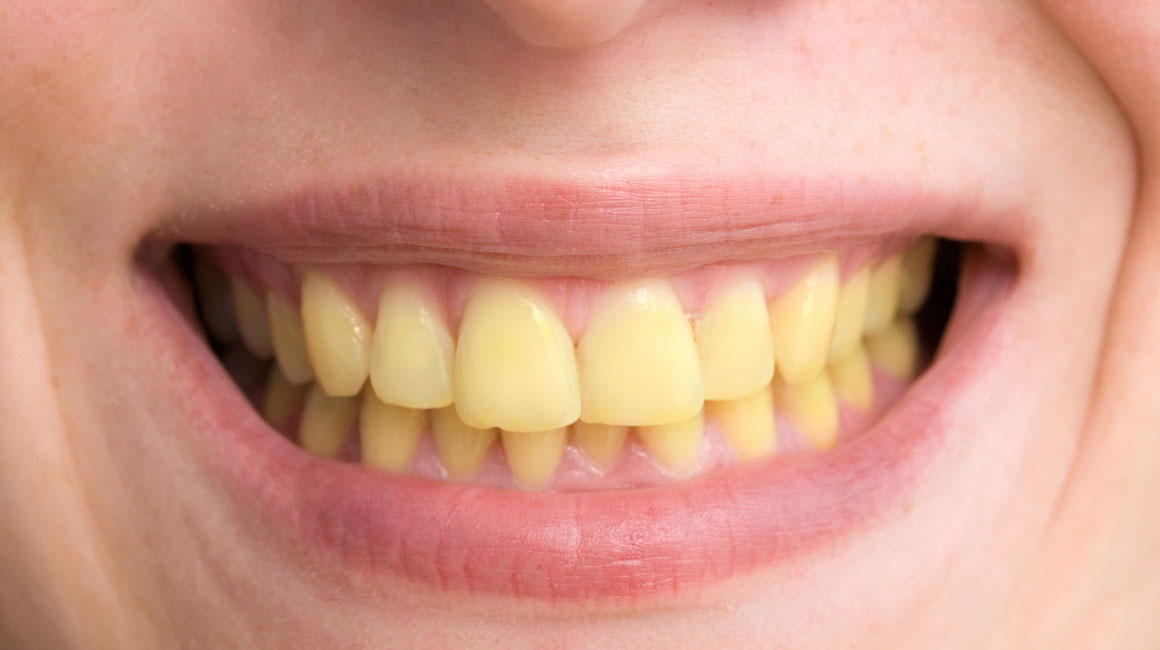 ما هى اسباب اصفرار الاسنان