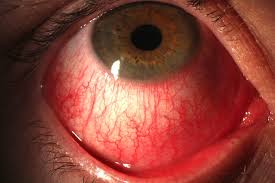 الطب البديل لعلاج حساسية العين 5