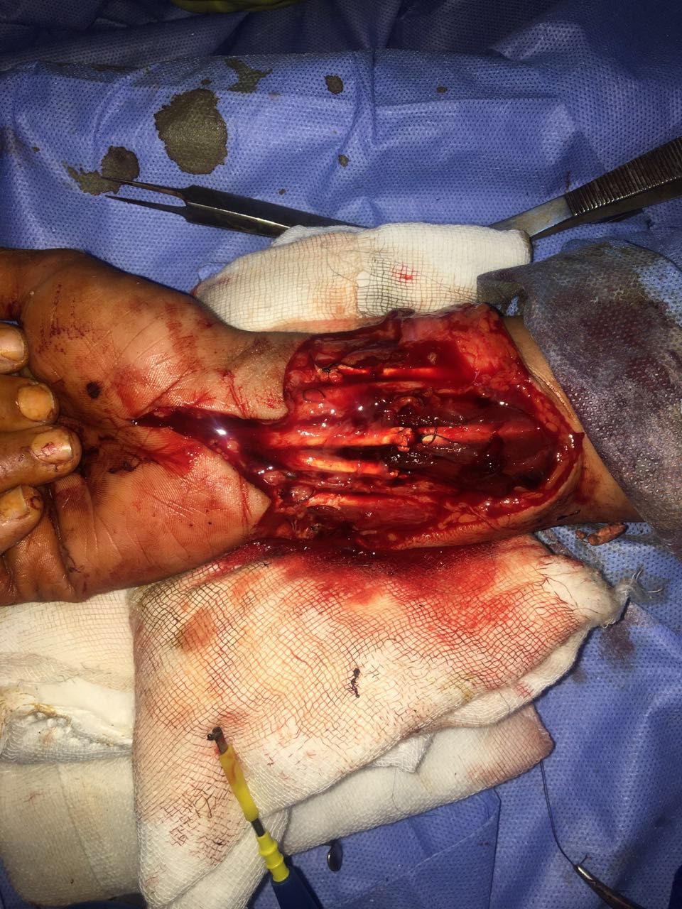 أطباء المستشفى الجامعى بسوهاج ينقذون يد فتاه من البتر (3)