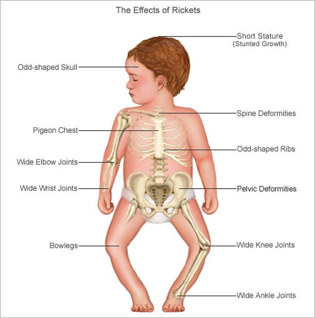 اعراض لين العظام وشكل الطفل المصاب بالكساح