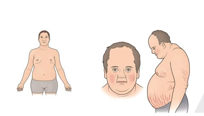 متلازمة متلازمة
