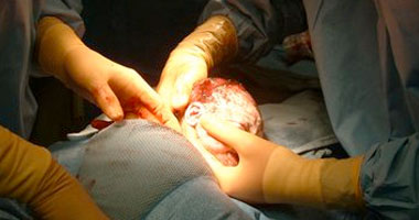 اضرار الولادة القيصرية 4