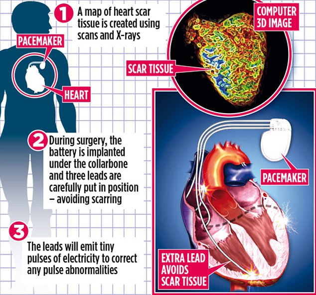 تحديد أفضل مكان لجهاز تنظيم ضربات القلب