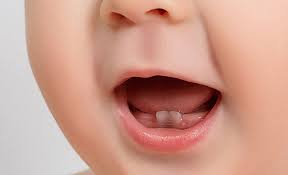 الاسنان الرمادية عند الاطفال