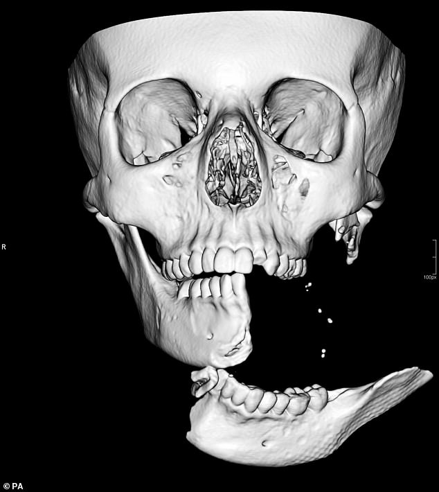 صورة لعظام الفك بعد كسره