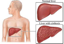 اعراض تليف الكبد