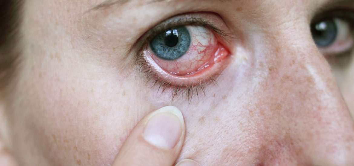 اعراض التهاب العين 2
