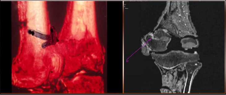 الأشعة المقطعية للعظام الفخذ الأيسر توت. السهام تشير إلى كسر مشتبه به