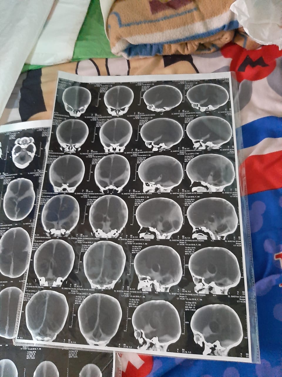 الأشعة المقطعية على المخ