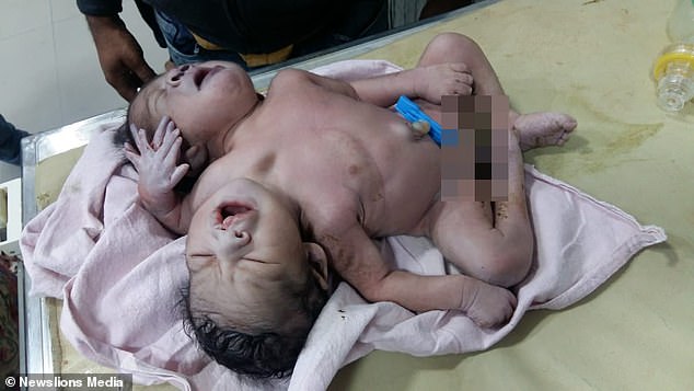 شاهد ولادة طفل برأسين و3 أذرع فى الهند وشكوك حول بقائه على قيد