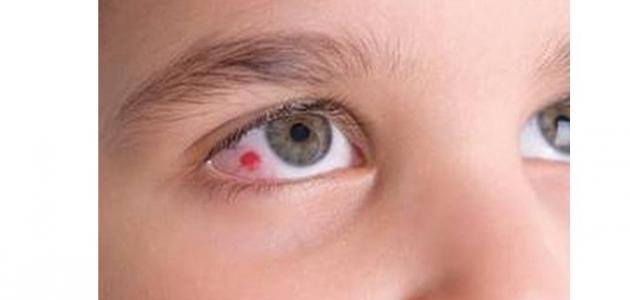 ما هي أسباب ظهور بقع دم داخل العين