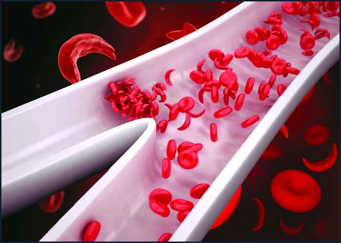 مرض الحمراء يصيب الدم الأنيميا هي خلايا الأنيميا هي