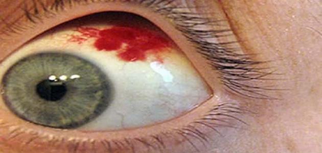 اسباب ظهور نقط دم داخل العين