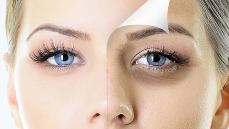 وصفات طبيعية لعلاج الهالات السوداء حول العين  (2)