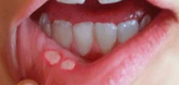 ما هي قرحة الفم
