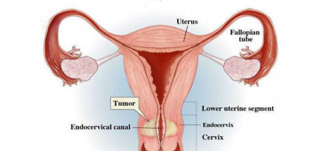 علامات سرطان الرحم