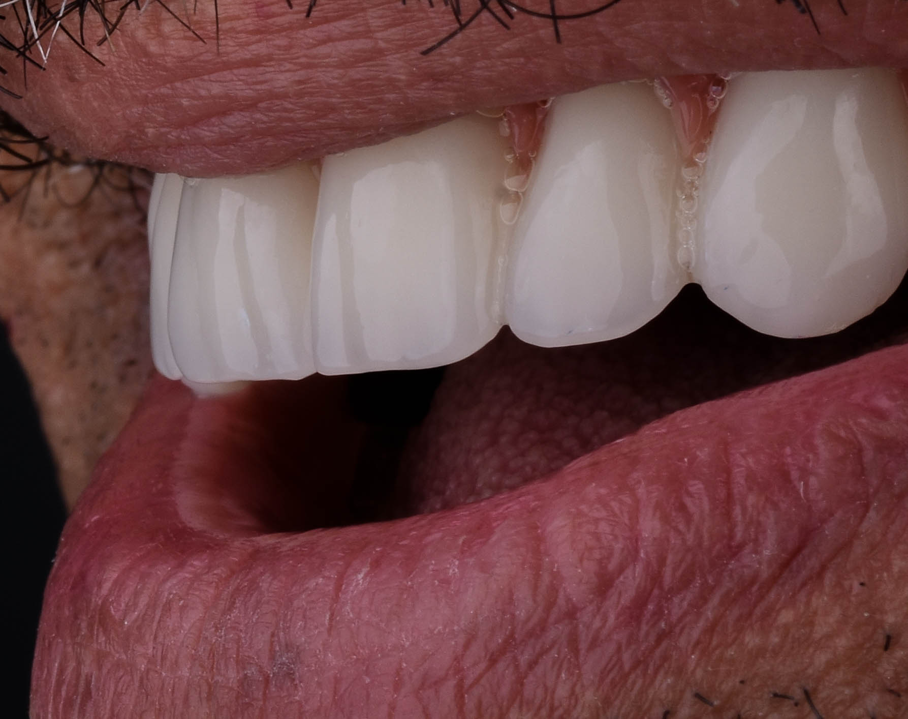 صورة للأسنان بعد الانتهاء من الزراعة داخل مركز شاينى وايت