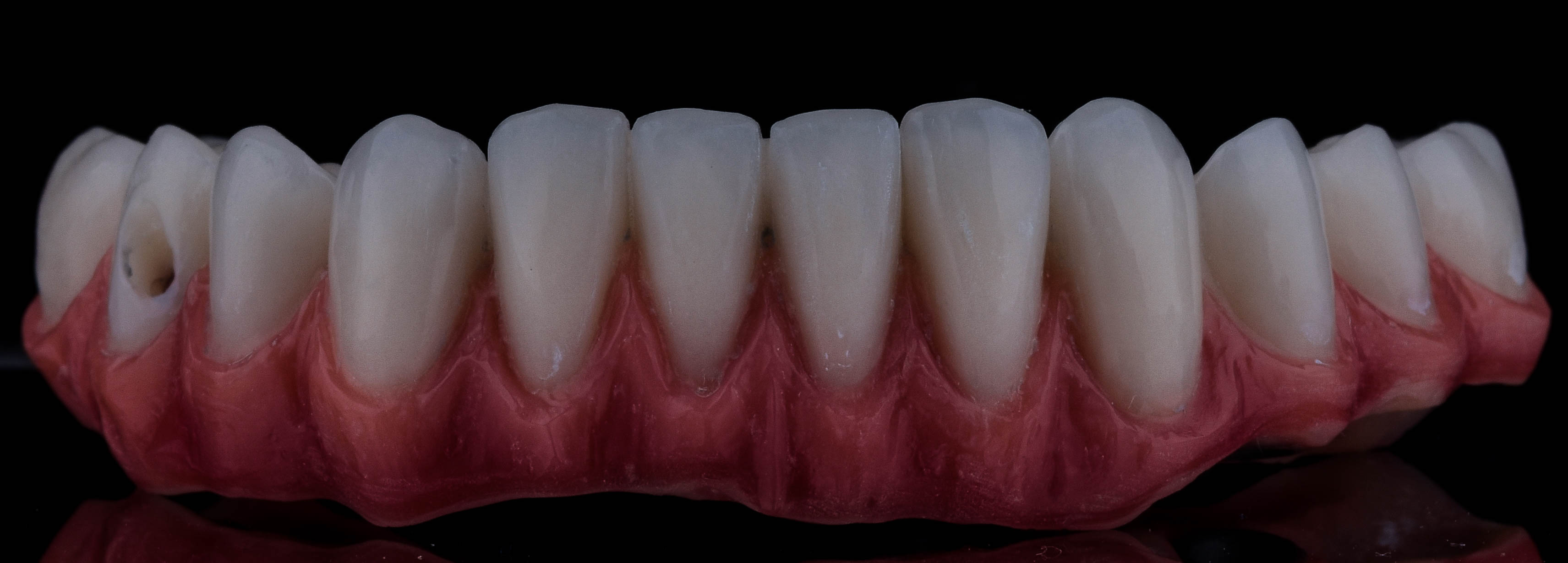 صورة توضح كيفية يتم البدء فى تركيب الأسنان بشكل كامل داخل الفم