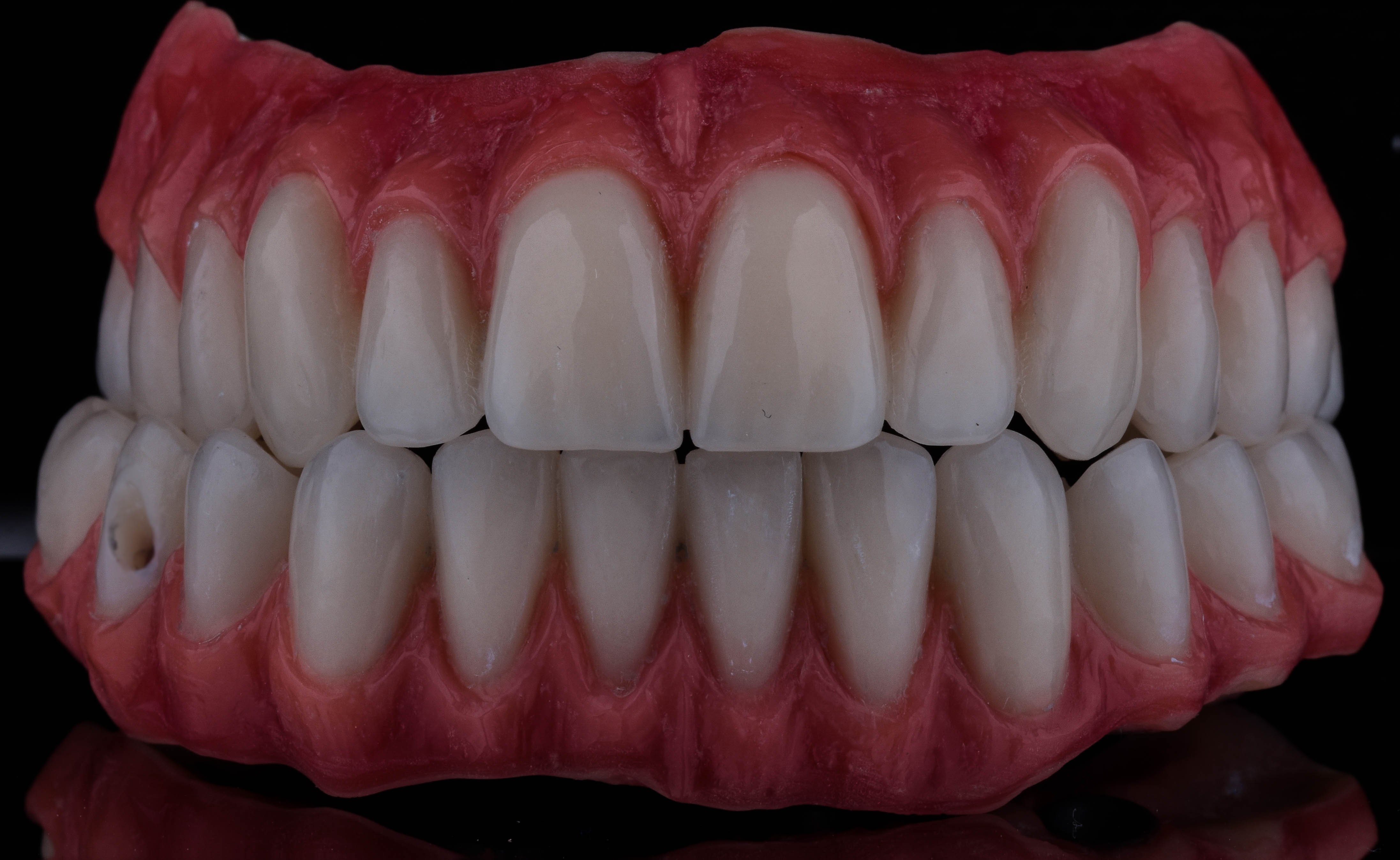 شكل الفك بعد تركيب الأسنان داخل مركز شاينى وايت