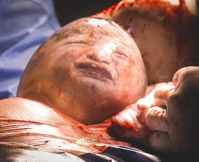 الطفل لحظة الولادة وخروجه وهو داخل كيس الجنين