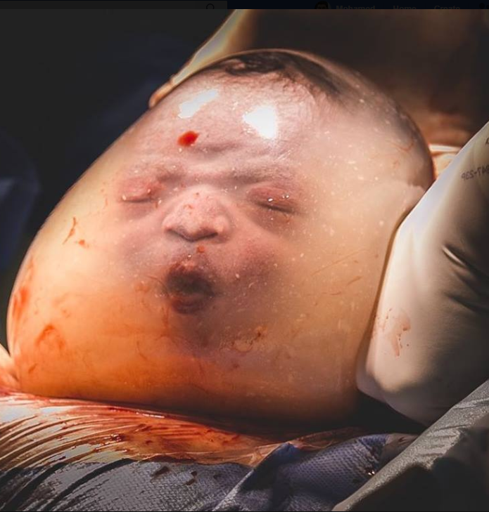 الطفل داخل كيس الجنين الذى يحميه طوال فترة تواجده مع أمه