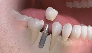 زراعة الاسنان وتطورها