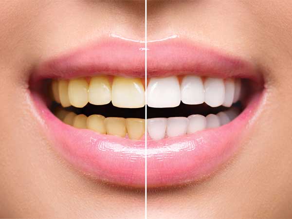 وصفات لنظافة الأسنان والتغلب على الأسنان الصفراء