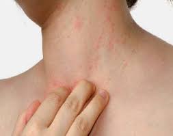 اعراض حساسية الجلد