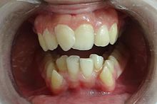 مشاكل الاسنان المعوجة