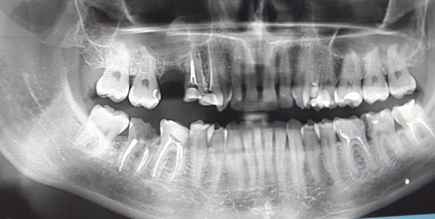 أشعة سينية على الأسنان