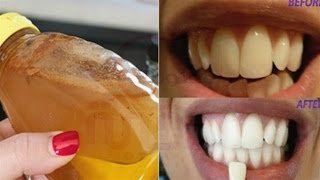 الاستخدام الثير لخل التفاح قد يسبب تأكل مينا الاسنان