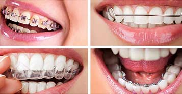 انواع تقويم الاسنان