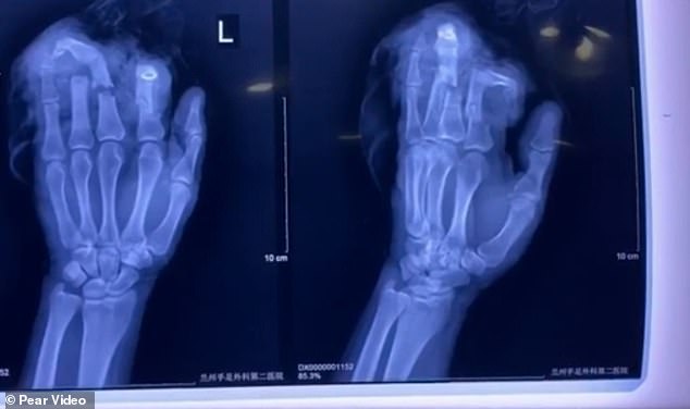 صورة من الأشعة بعد قطع الرجل أصابعه