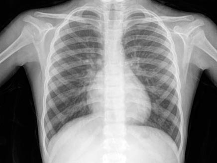 الأشعة السينية للصدر