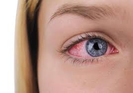 اعراض جفاف العين 1