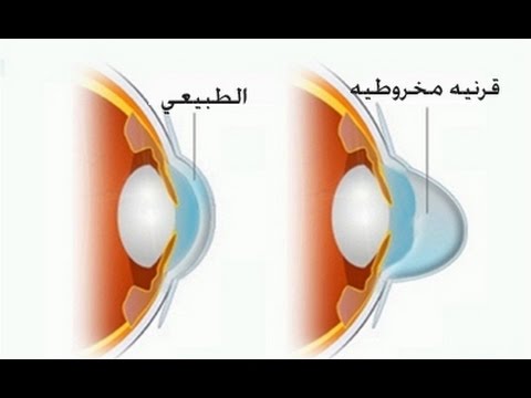 شكل القرنية المخروطية