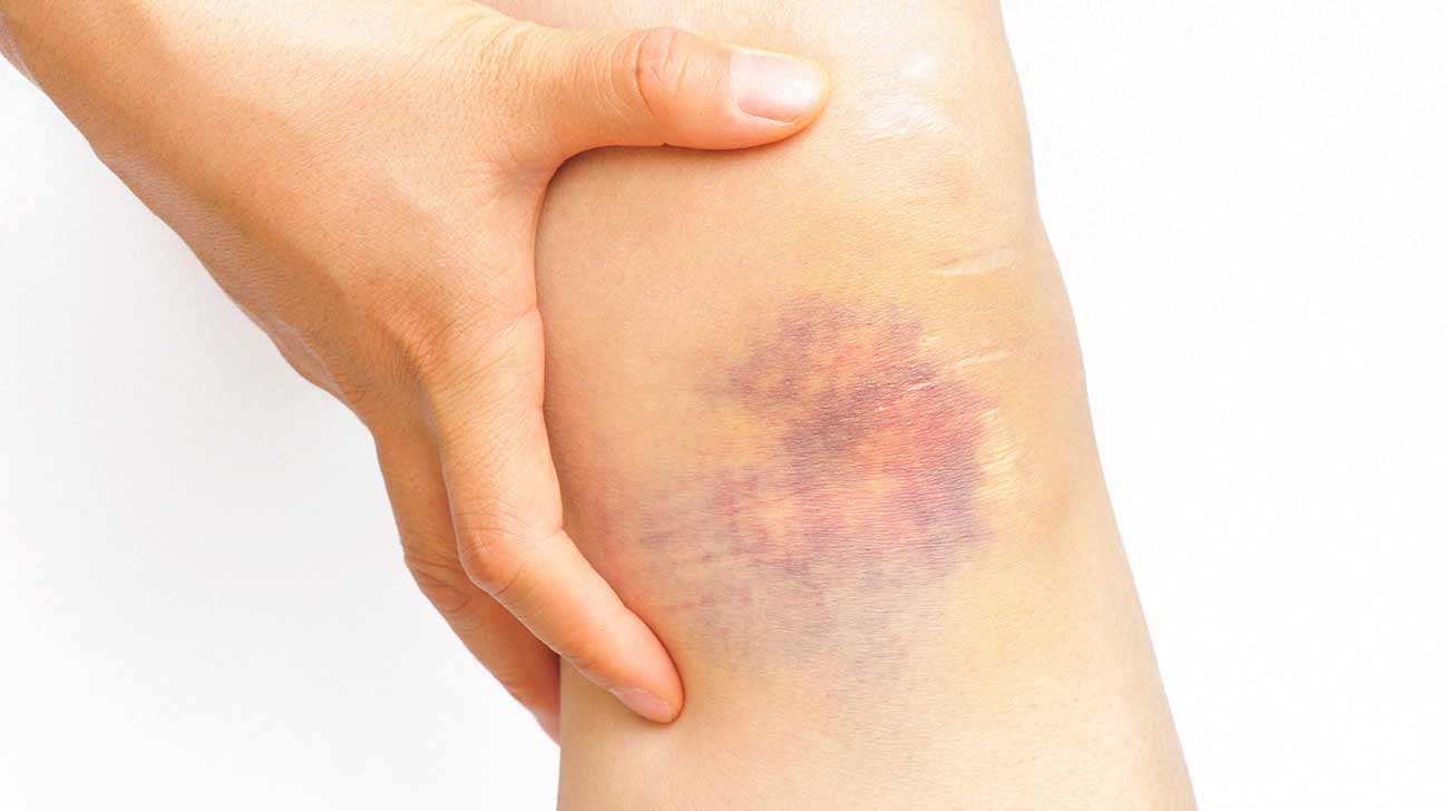 1296x728_bruise-colors-H1