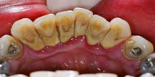ما هو جير الأسنان