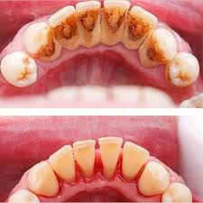 اضرار تكون طبقة الجير على الاسنان