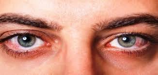 اضرار جفاف العين 1