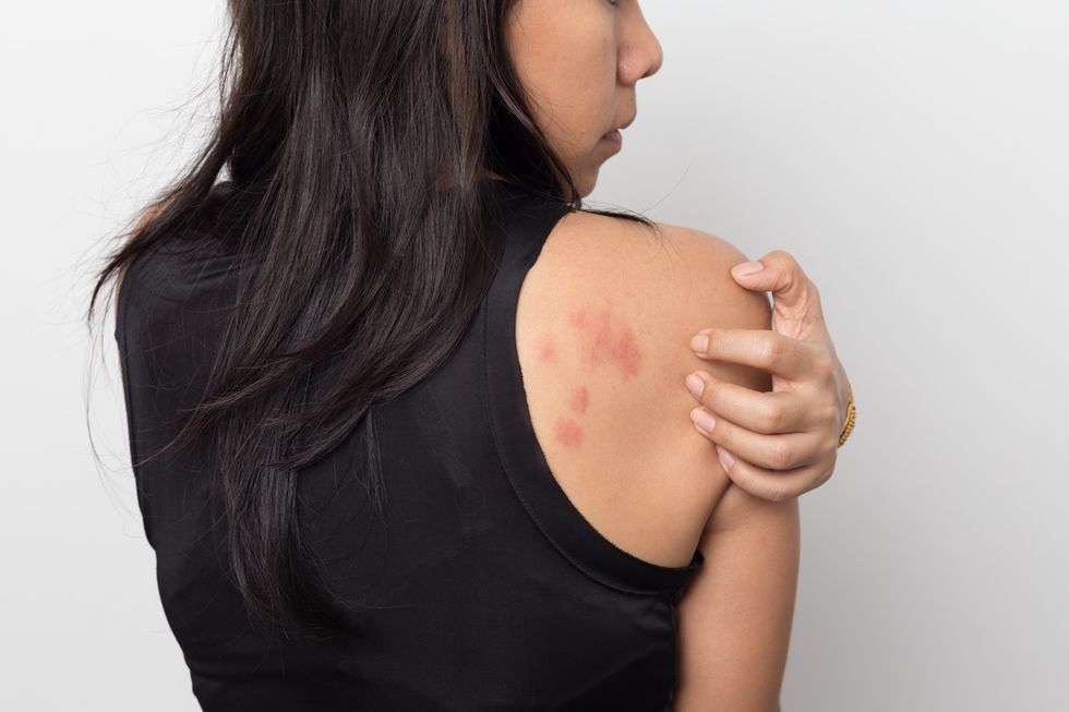 woman-showing-her-skin-itching-behind-with-allergy-royalty-free-image-1092057258-1554226840