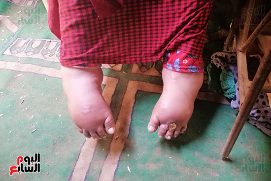 مأساة شقيقتين من سوهاج مصابتين بالشلل (3)