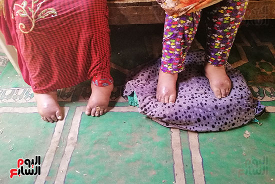 مأساة شقيقتين من سوهاج مصابتين بالشلل (5)