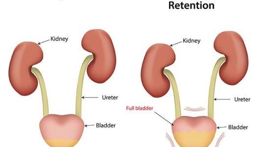اضرار احتباس البول