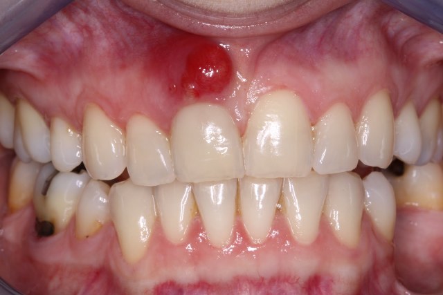 خراج الاسنان1