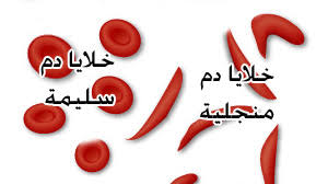 فقر الدم المنجلي 1