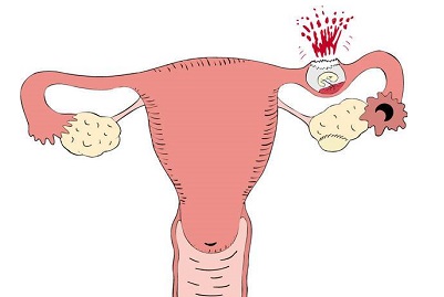 تجربتي مع الحمل خارج الرحم 1