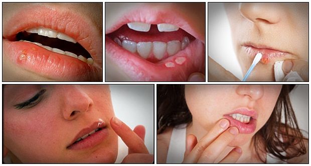 13-tips-on-how-to-get-rid-of-cold-sores-naturally-can