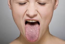 اعراض جفاف الفم