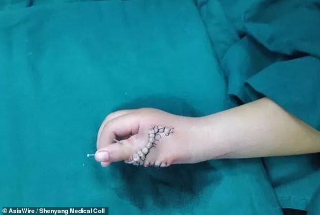 طفلة لديها 14 إصبع بعد العلاج